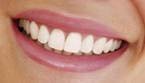 blanqueamiento de dientes